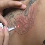 Tatuaggi troppo colorati? Non sempre i laser sono efficaci