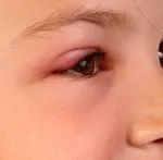 Riconoscere le infezioni degli occhi: congiuntiviti, blefariti e orzaioli