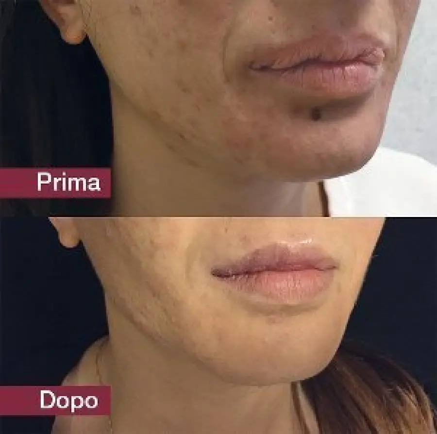 Il silicone liquido nella labbra può sfigurare una persona. Ecco come rimediare