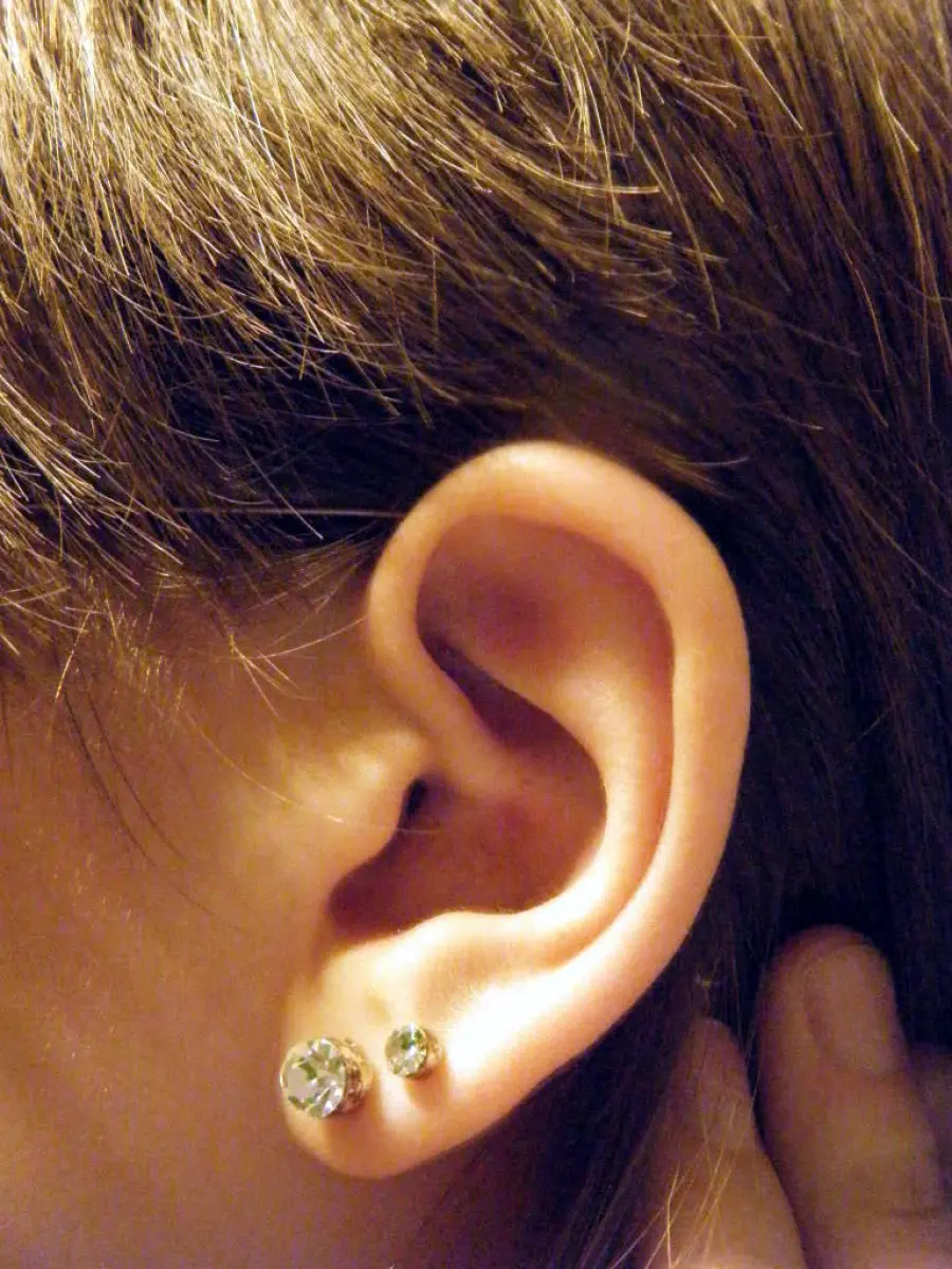 Orecchie a sventola, addio per sempre: ecco l’intervento che risolve in modo definitivo l’inestetismo