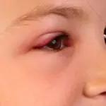 Riconoscere le infezioni degli occhi: congiuntiviti, blefariti e orzaioli