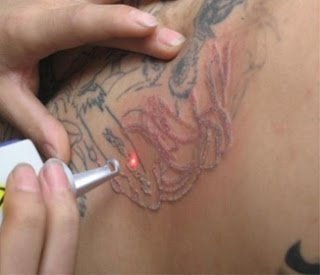 Tatuaggi troppo colorati? Non sempre i laser sono efficaci
