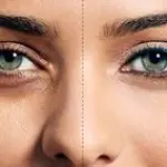 Via borse e occhiaie con una punturina