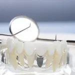 Tutto quello che devi sapere sull’implantologia a carico immediato