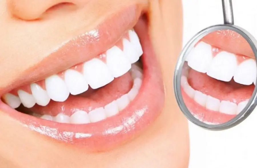 Come avviene lo sbiancamento dei denti