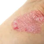 La pelle secca come conseguenza della psoriasi