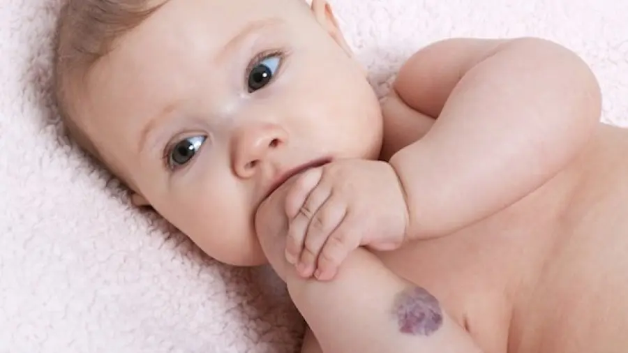 Emangiomi infantili: le cause e la nuova cura in Italia