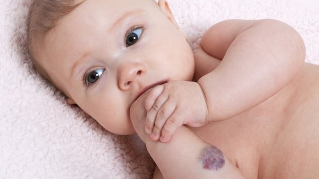 Emangiomi infantili: le cause e la nuova cura in Italia