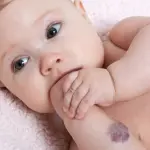 Emangiomi infantili: le cause e la nuova cura in Italia