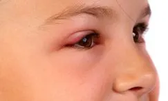 Riconoscere le infezioni degli occhi: congiuntiviti, blefariti e orzaioli