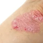 La pelle secca come conseguenza della psoriasi